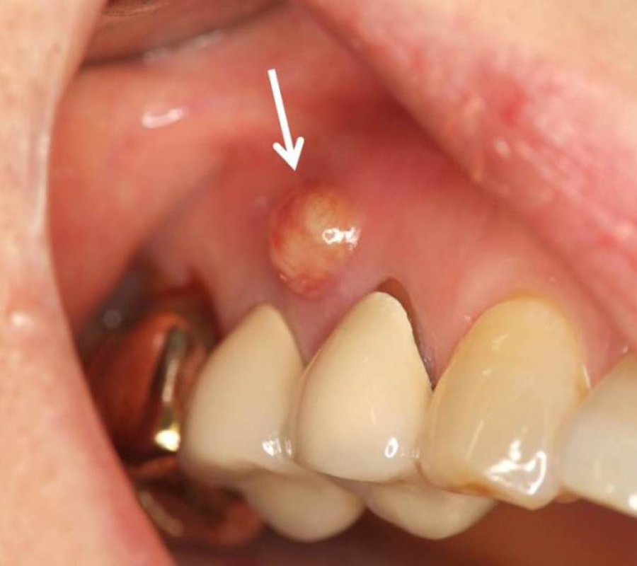 付け根 口内炎 歯茎 見極めがポイント！歯茎のできものは口内炎か？ほかの病気か？