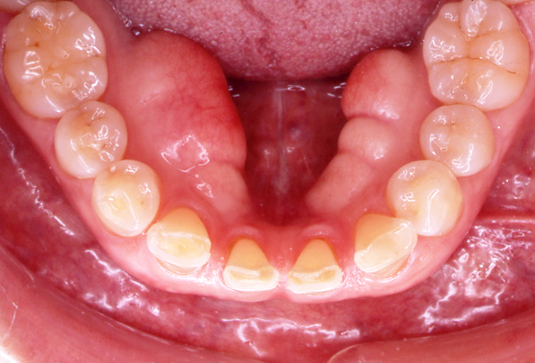 口の中のできもの - 岩見沢の歯医者なら鳩が丘歯科クリニック｜矯正 