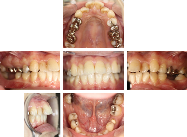 症例3 ハイラックスrmeにより 上顎の劣成長による諸症状を改善した症例 岩見沢の歯医者なら鳩が丘歯科クリニック 矯正 インプラントに実績