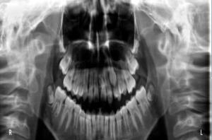 岩見沢の歯医者なら、歯を抜かない矯正治療で評判の鳩が丘歯科クリニック