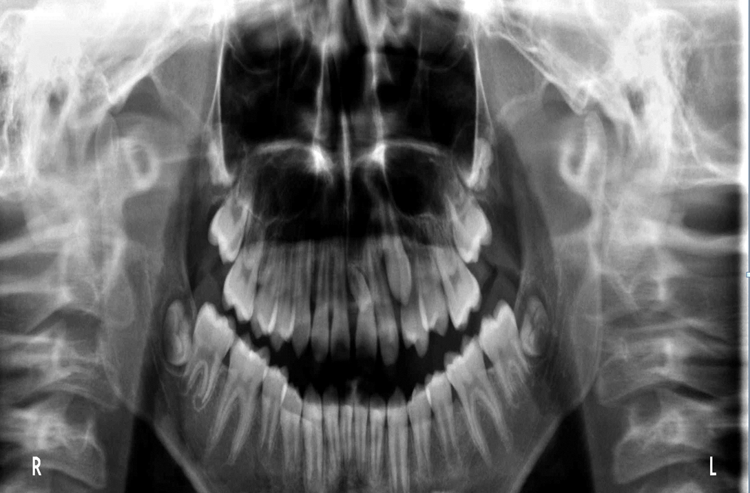 歯が多くなっちゃった 過剰歯 岩見沢の歯医者なら鳩が丘歯科クリニック 矯正 インプラントに実績