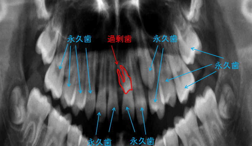 岩見沢の歯医者なら、歯を抜かない矯正治療で評判の鳩が丘歯科クリニック