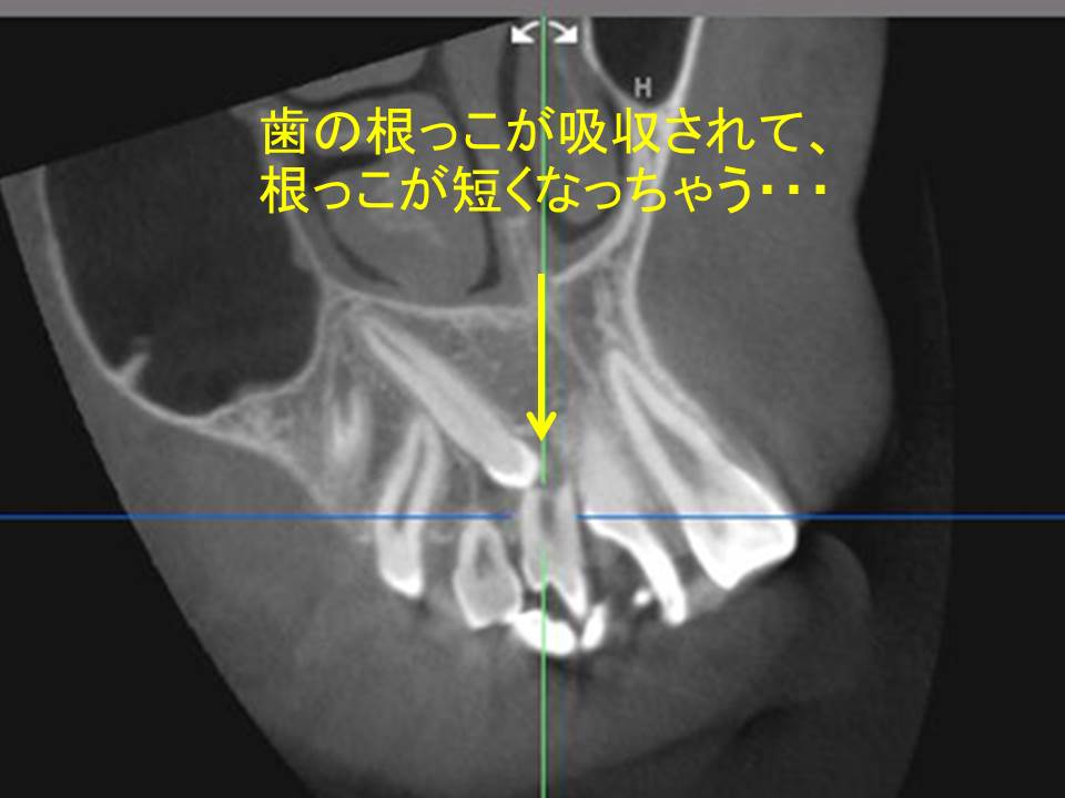 乳歯が抜けたのに永久歯が生えてこない 永久歯 生えない 岩見沢の歯医者なら鳩が丘歯科クリニック 矯正 インプラントに実績