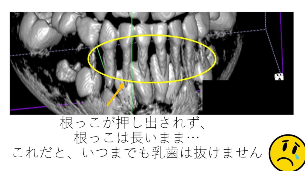 乳歯は抜けたけど永久歯が中々生えてこない 岩見沢の歯医者なら鳩が丘歯科クリニック 矯正 インプラントに実績