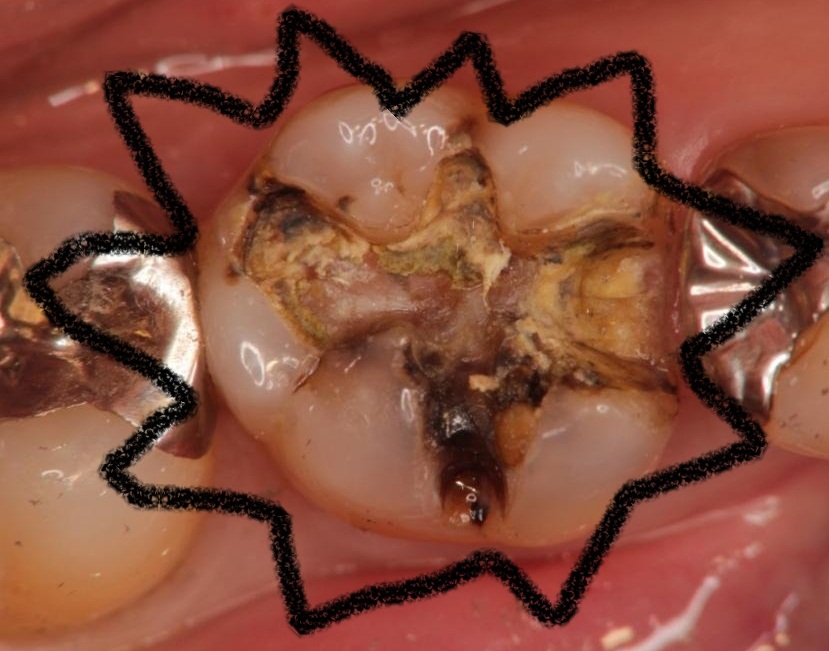 銀歯から匂いが 岩見沢の歯医者なら鳩が丘歯科クリニック 矯正 インプラントに実績