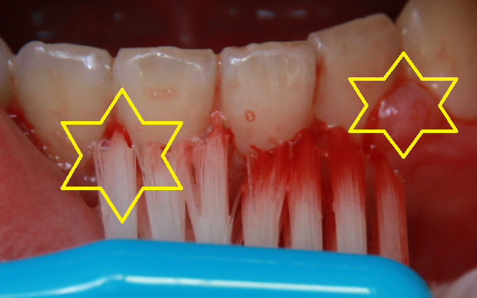 歯 と 歯茎 の 間 から 血